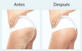 ¿Qué es la carboxiterapia y cómo ayuda a una evolución estética natural?